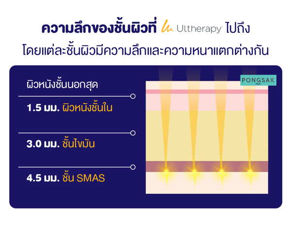 ulthera_ultheraที่ไหนดี_ultheraspt_ultherafirst__ultheraกี่line_ยกกระชับหน้า_pongsakclinic