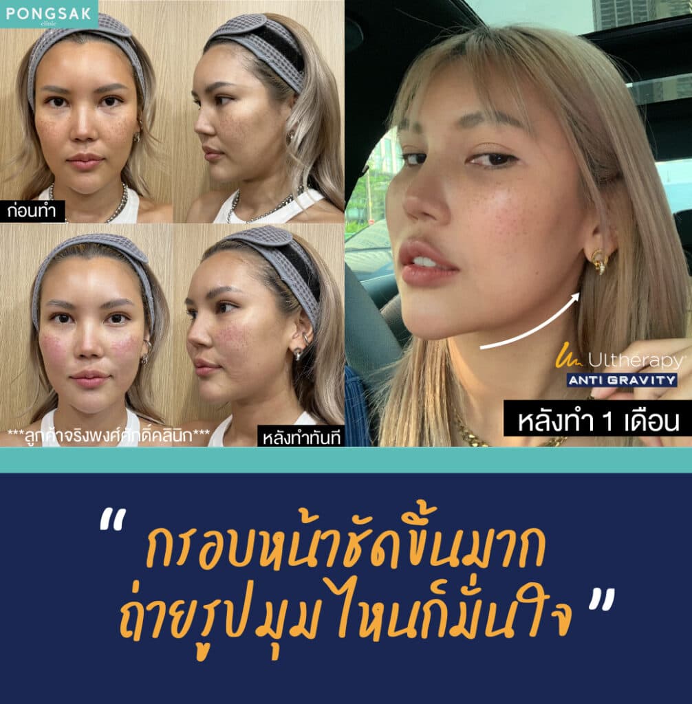 ulthera ราคา