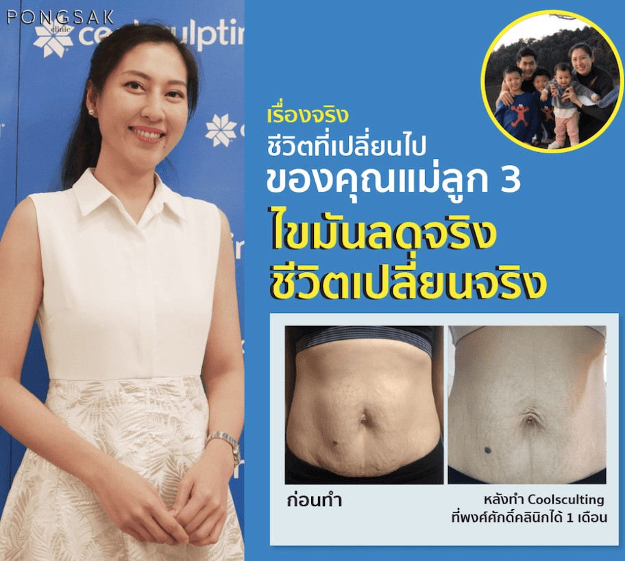 coolsculpting_ulthera_thermage_pongsakclinic