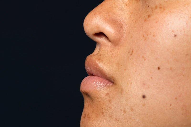 How much does laser freckles cost? Laser freckles, how many times do you see results? Are they permanently gone?