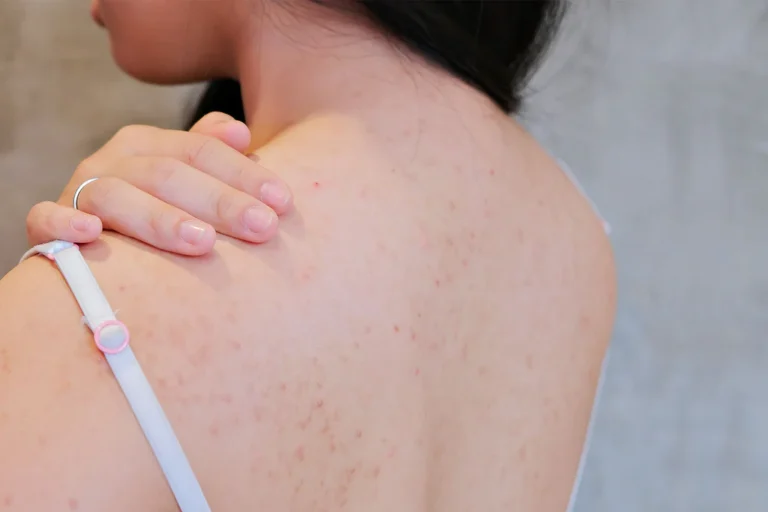 Laser acne scars on the back